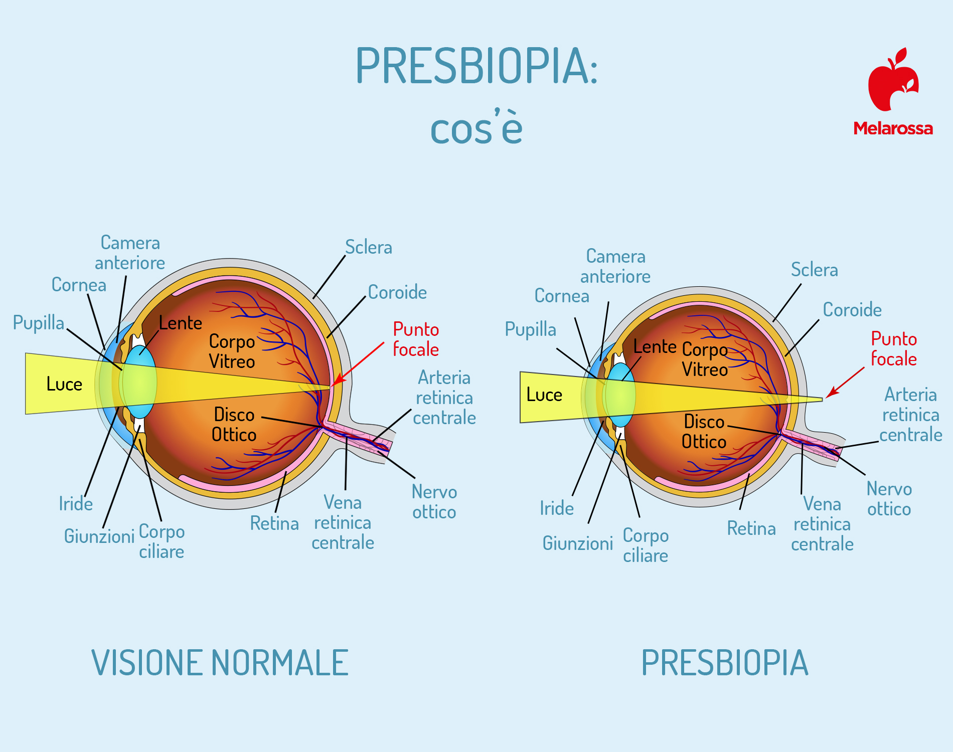 Presbiopia: cos’è, sintomi, cause, età di insorgenza, interazione con altri difetti visivi, correzioni e cura 1 presbiopia: cos'è