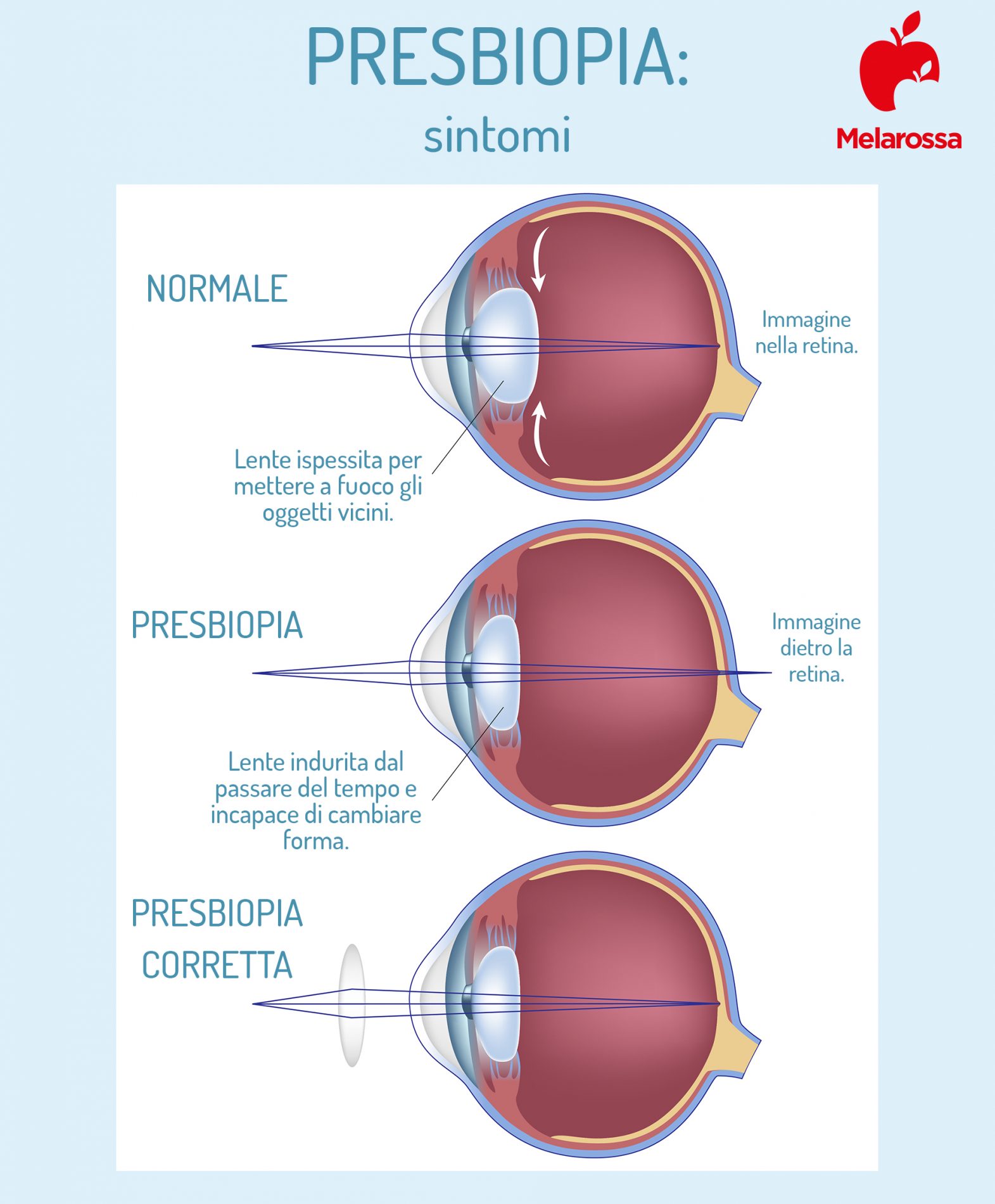 Presbiopia: cos’è, sintomi, cause, età di insorgenza, interazione con altri difetti visivi, correzioni e cura 2 presbiopia: sintomi e come correggere il difetto