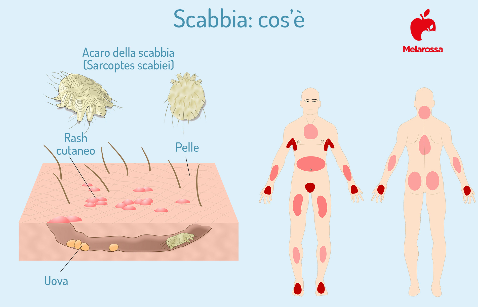 Scabbia: cos’è, tipi, come si trasmette, sintomi, diagnosi, cure e prevenzione 1 scabbia: cos'è