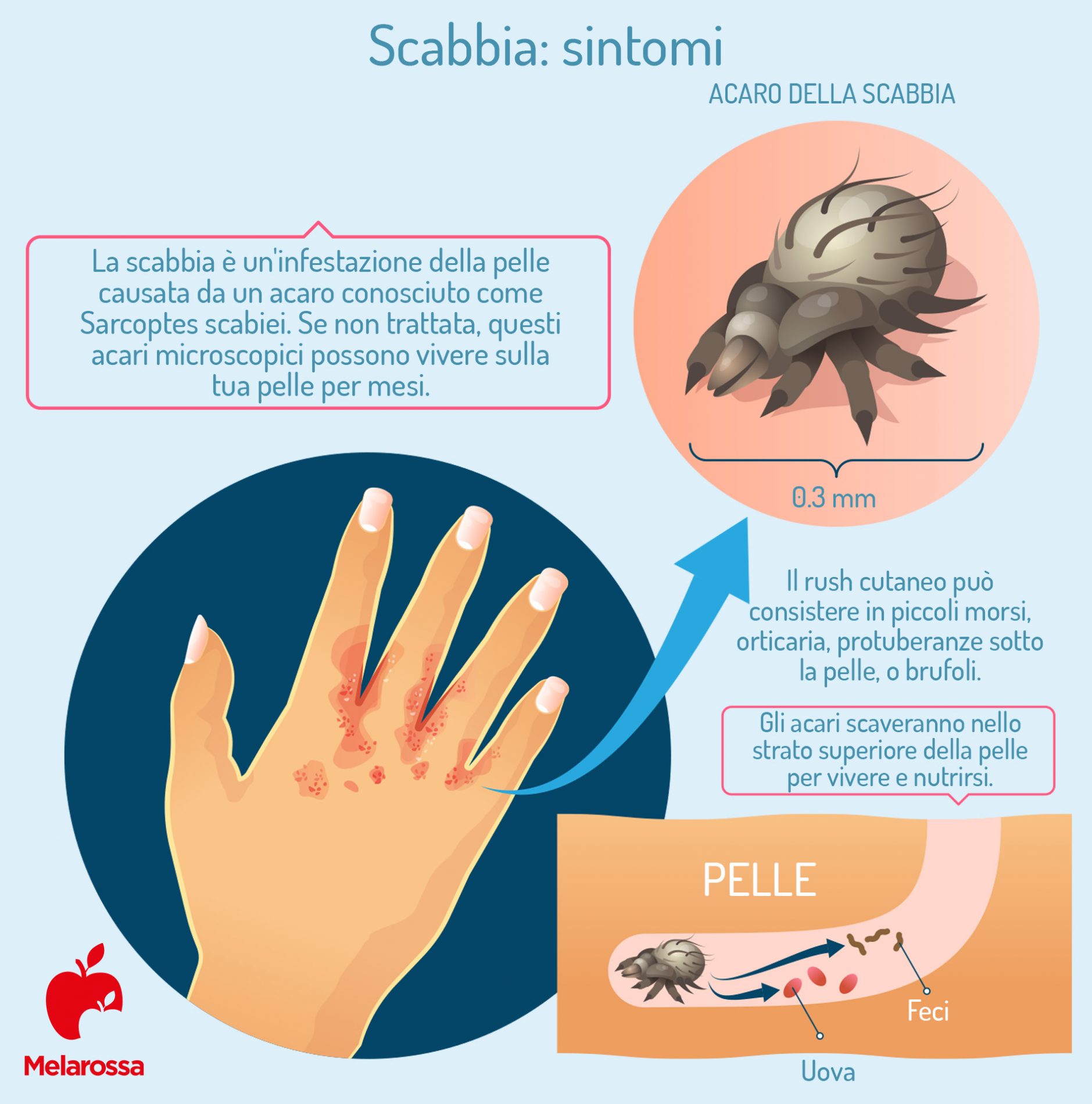 Scabbia: cos’è, tipi, come si trasmette, sintomi, diagnosi, cure e prevenzione 3 scabbia: sintomi