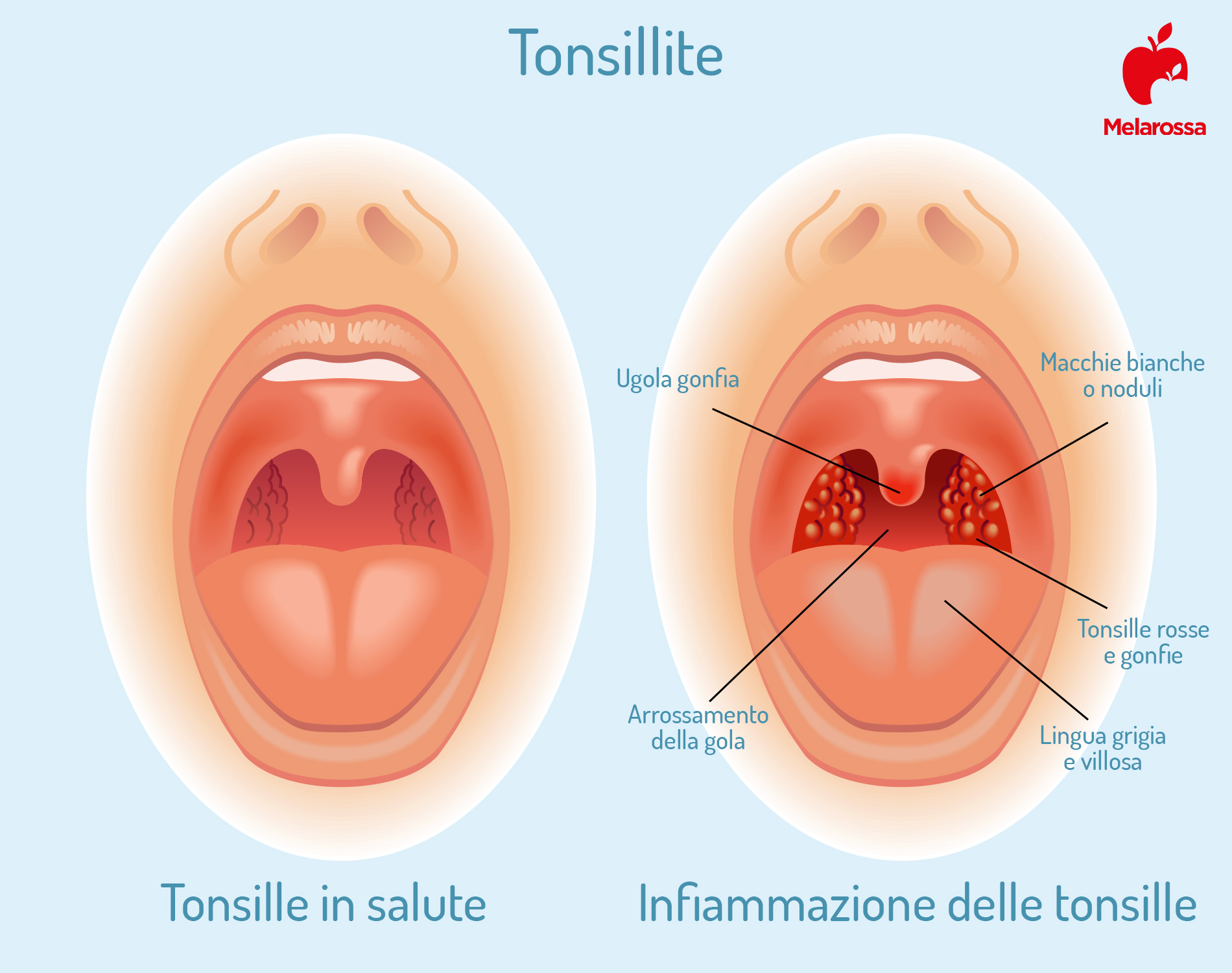 Tonsillite: cos’è, sintomi, rimedi e prevenzione 1 tonsillite o tonsille gonfie: cos'è