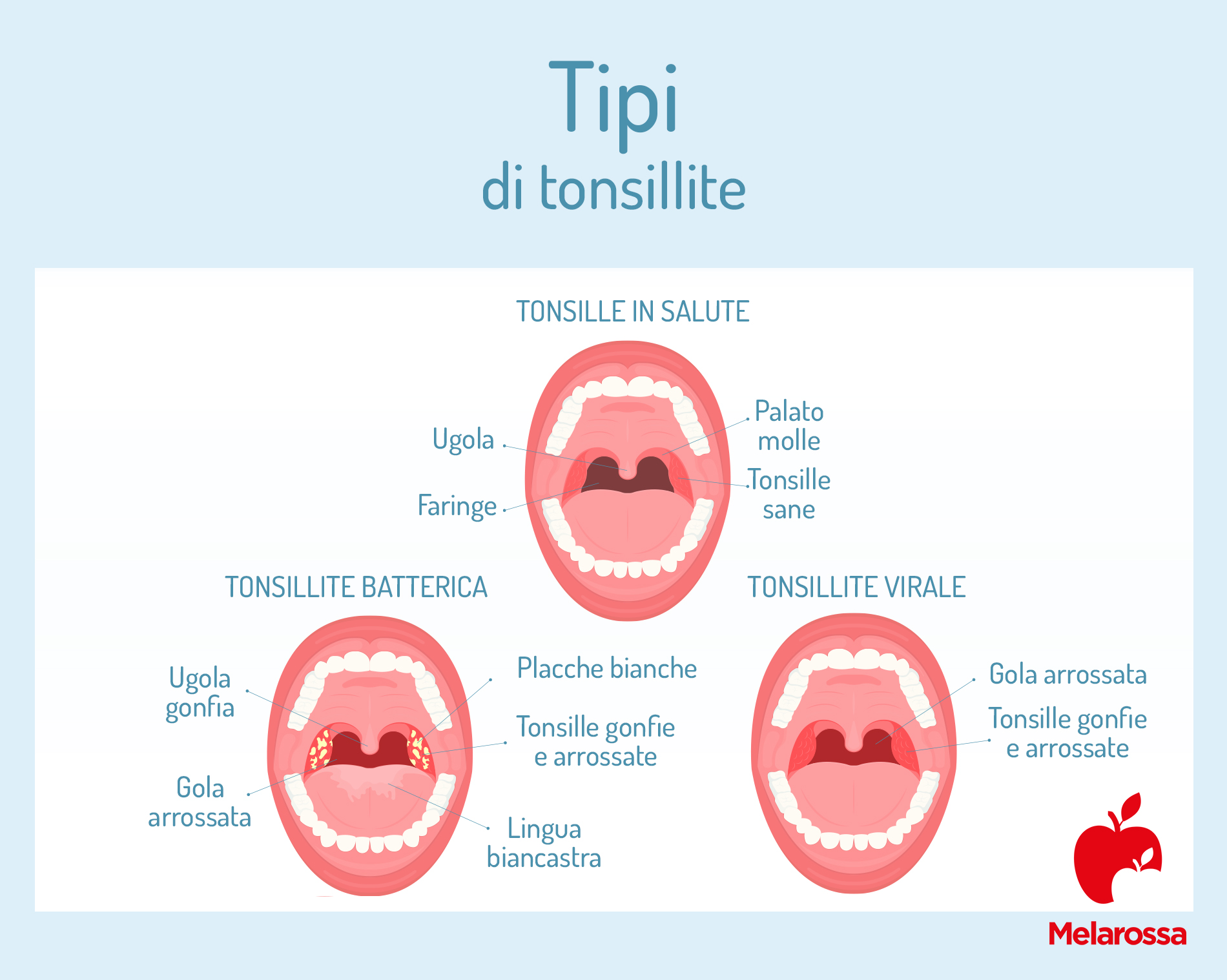 Tonsillite: cos’è, sintomi, rimedi e prevenzione 2 tipi di tonsillite