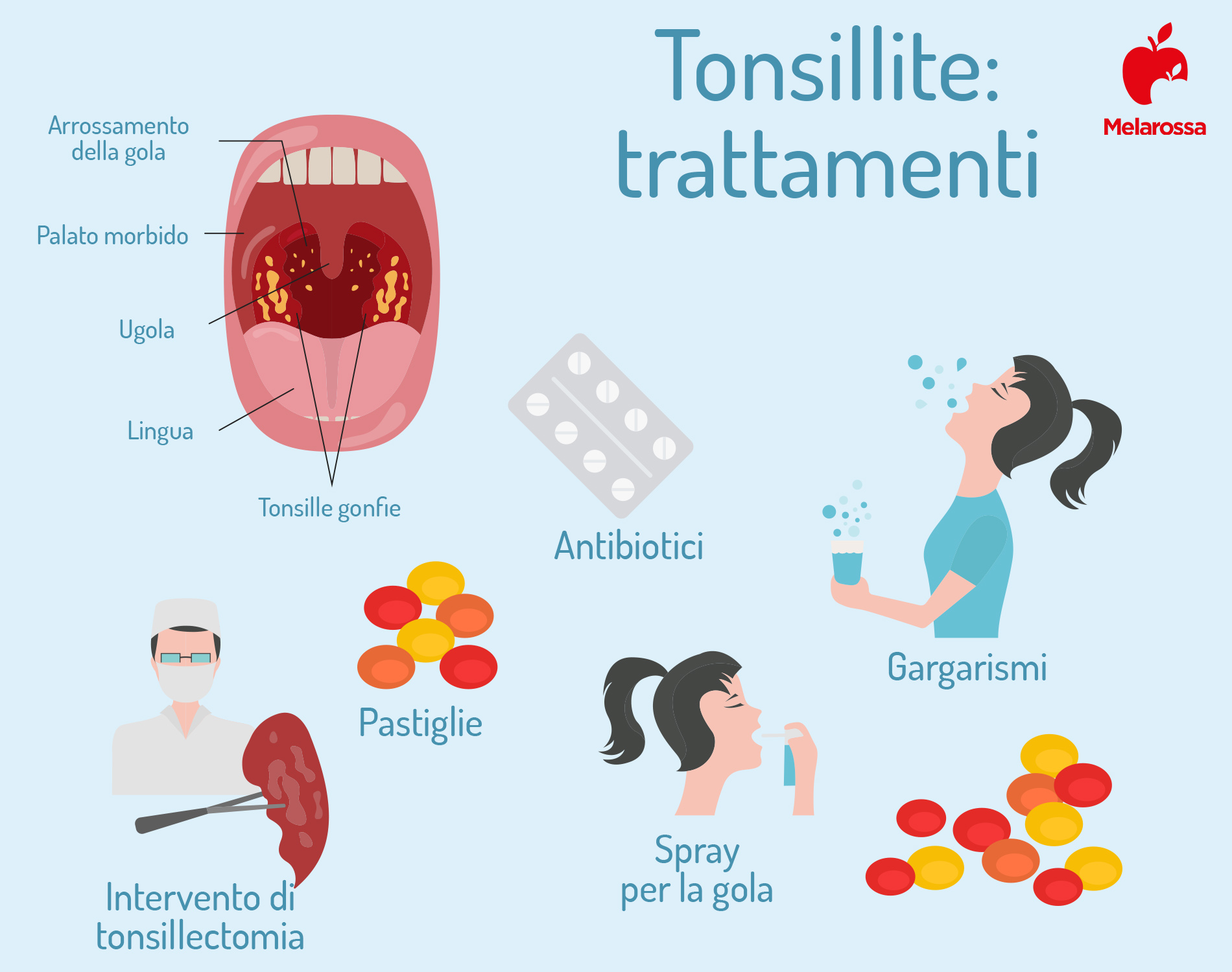 Tonsillite: cos’è, sintomi, rimedi e prevenzione 6 tonsillite: trattamenti