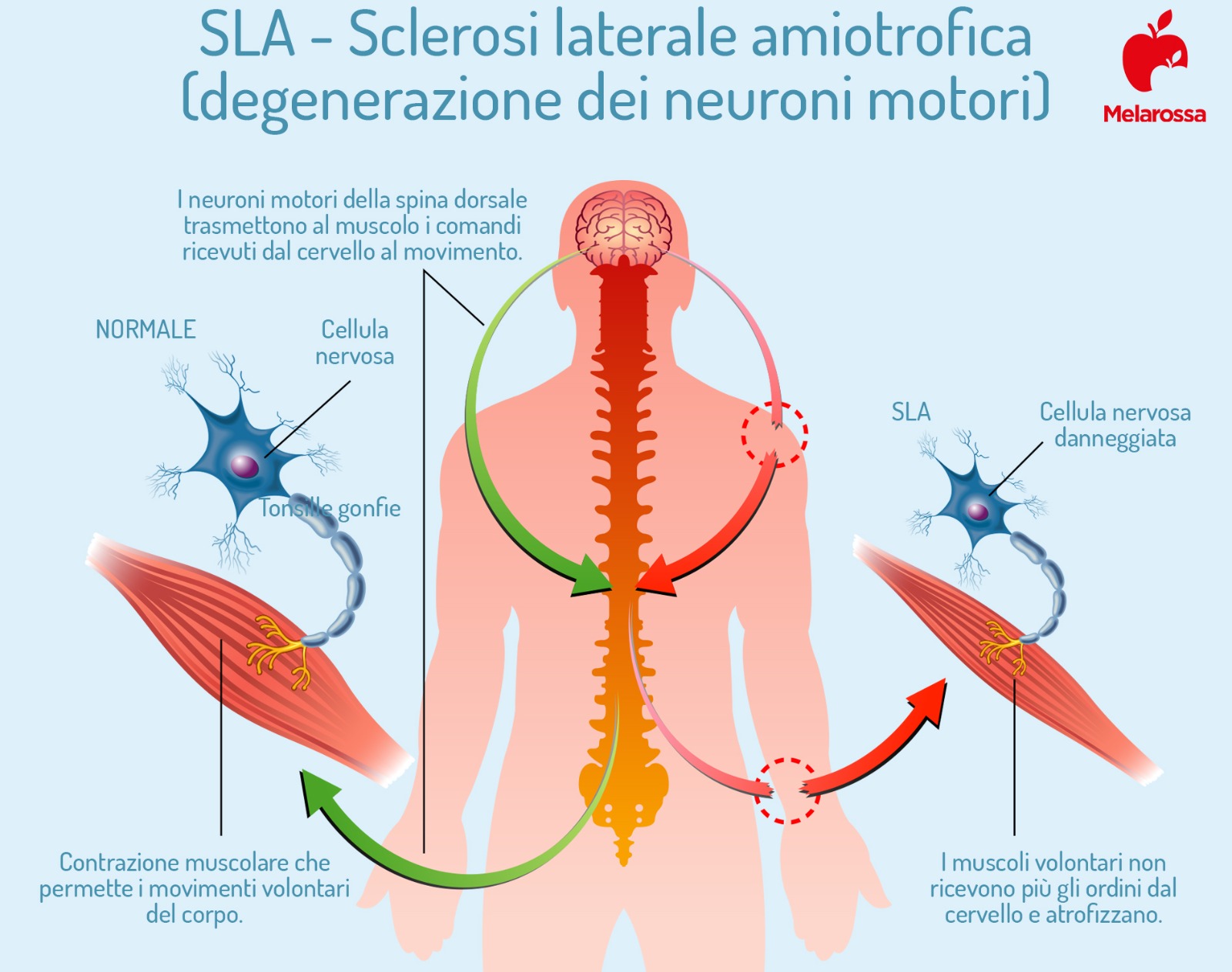 SLA o Sclerosi Laterale Amiotrofica : cos’è, chi colpisce, sintomi, cause, diagnosi, terapie disponibili e assistenza malati 2 SLA degenerazione neuroni motori