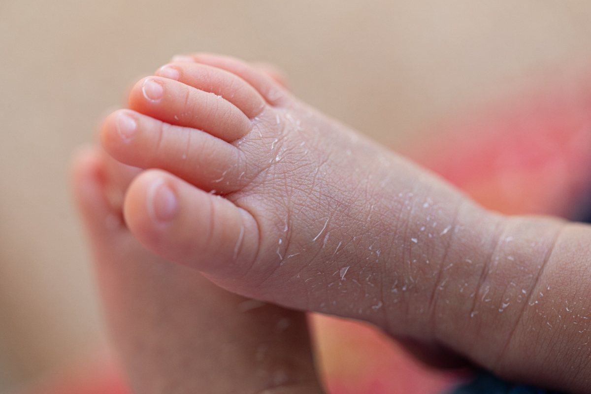 Dermatite da contatto: cos’è, come si classifica, cause, sintomi, cure, rimedi naturali e come prevenire 2 chi soffre di dermatite da contatto