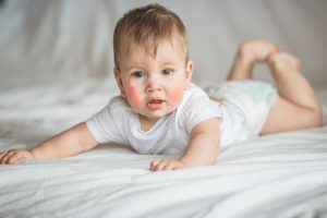 Dermatite atopica : cos&rsquo;&egrave;, chi colpisce, cause, sintomi, diagnosi, trattamenti e rimedi
