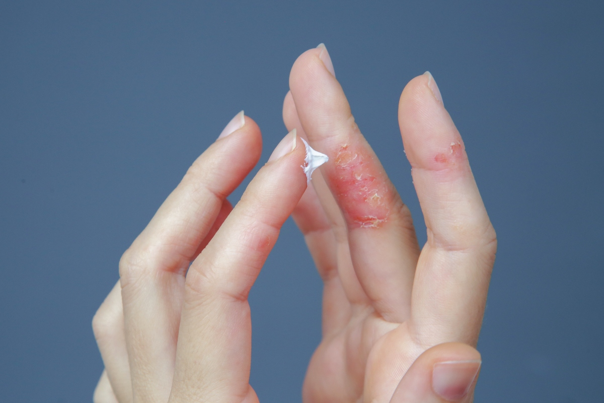 Dermatite atopica : cos’è, chi colpisce, cause, sintomi, diagnosi, trattamenti e rimedi 4 dermatite atopica: cure
