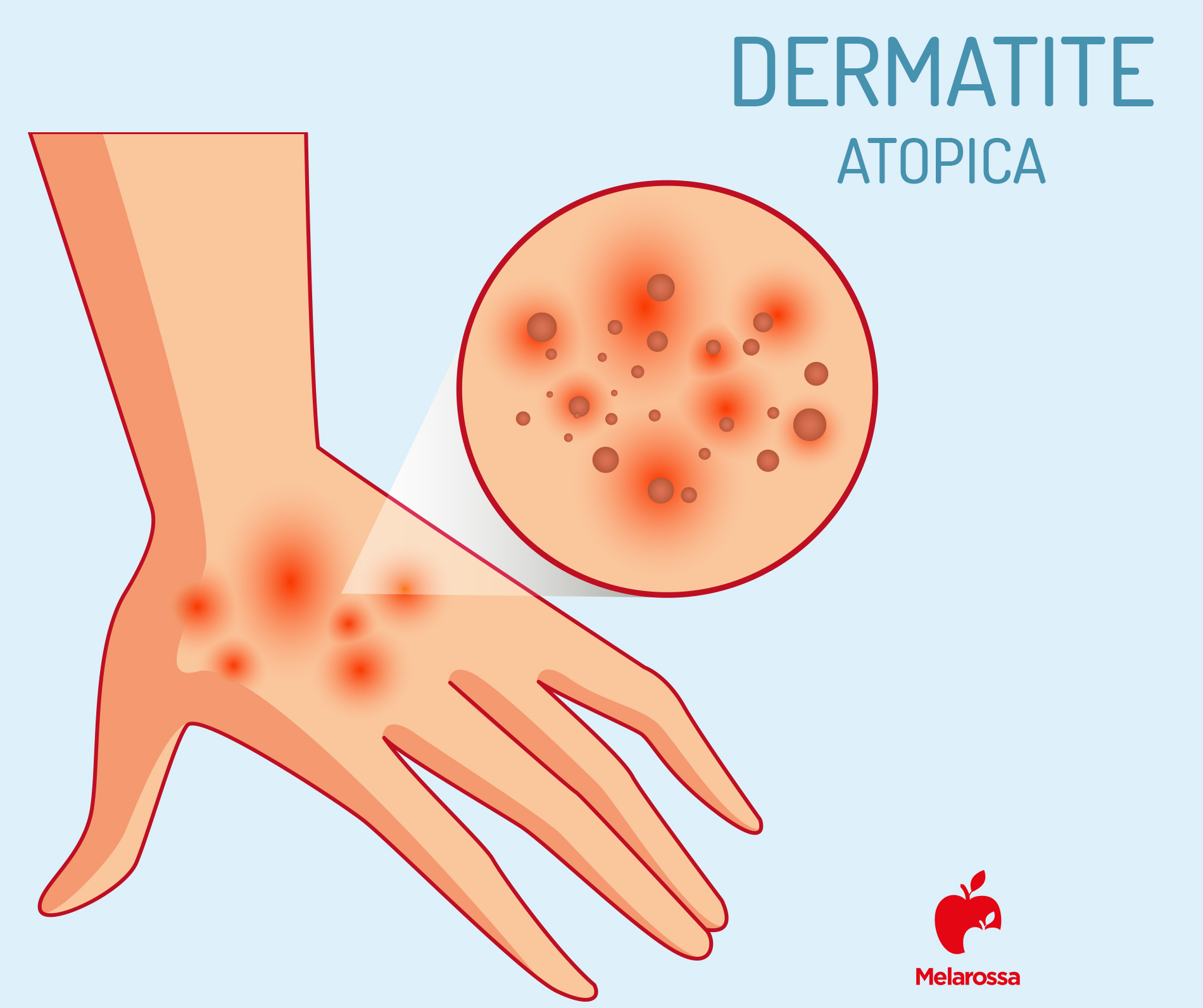 Dermatite atopica : cos’è, chi colpisce, cause, sintomi, diagnosi, trattamenti e rimedi 1 dermatite atopica delle mani