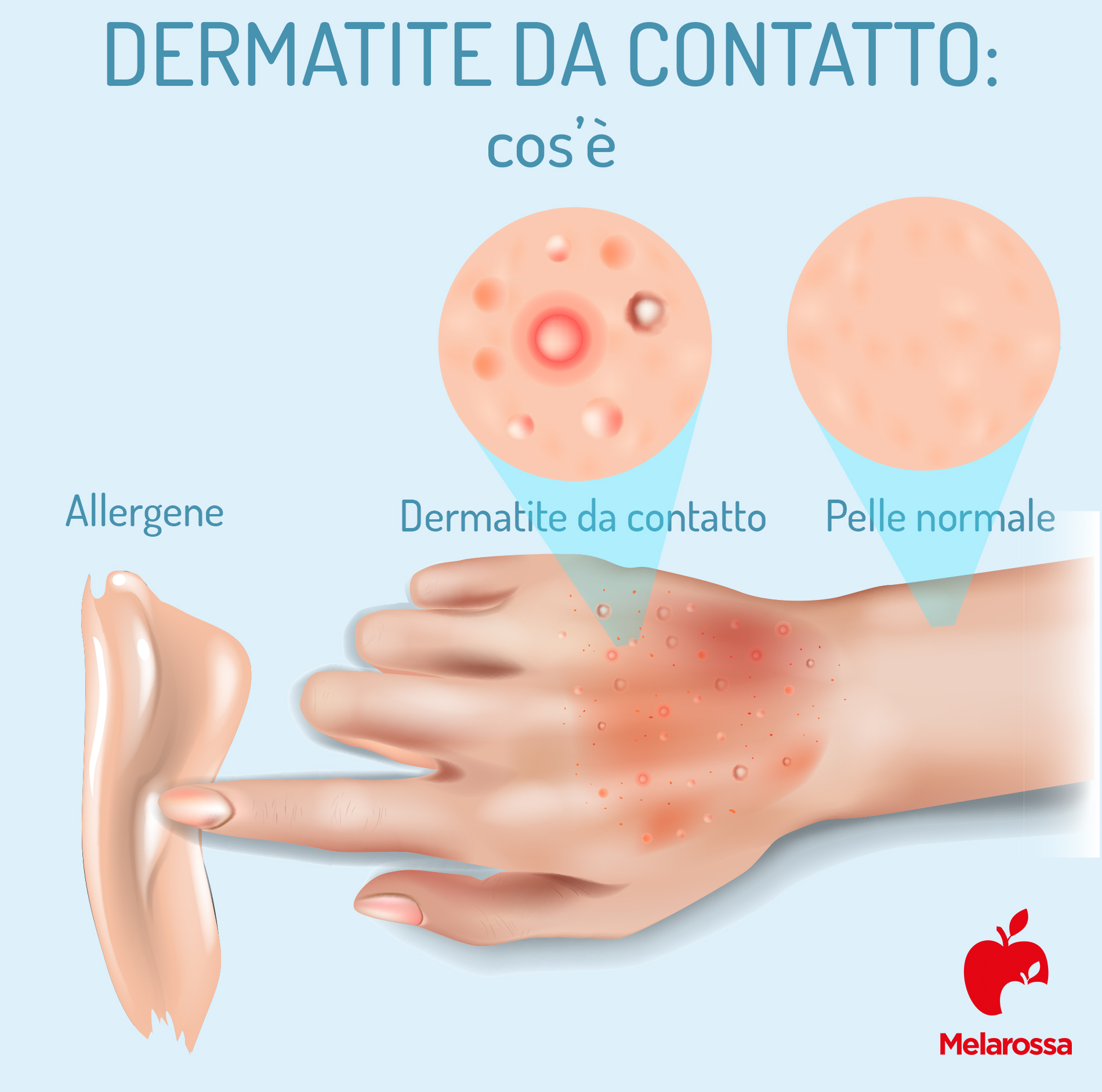 Dermatite da contatto: cos’è, come si classifica, cause, sintomi, cure, rimedi naturali e come prevenire 1 dermatite da contatto: cos'è