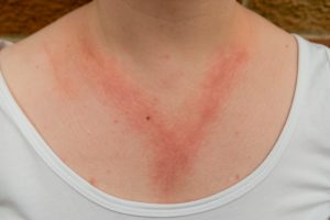 Dermatite da contatto: cos&rsquo;&egrave;, come si classifica, cause, sintomi, cure, rimedi naturali e come prevenire