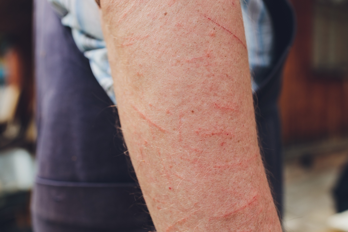 Dermatite da contatto: cos’è, come si classifica, cause, sintomi, cure, rimedi naturali e come prevenire 4 dermatite da contatto: sintomi