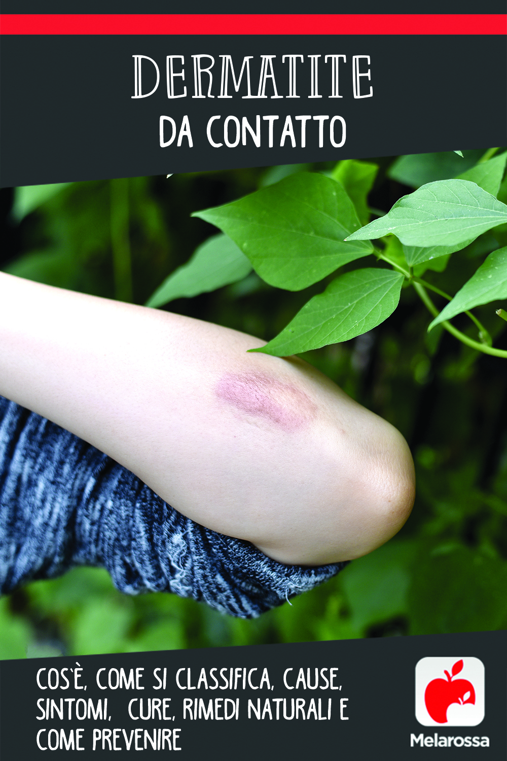 Dermatite da contatto: cos’è, come si classifica, cause, sintomi, cure, rimedi naturali e come prevenire 8 dermatite da contatto: cos'è, cause, sintomi e cure