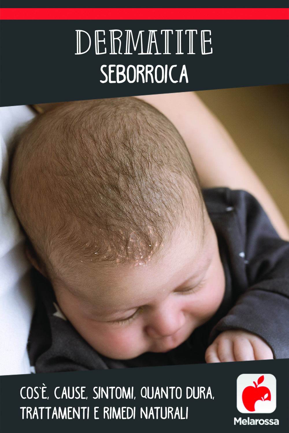 Dermatite seborroica: cos’è, cause, sintomi, quanto dura, trattamenti e rimedi naturali 9 dermatite seborroica: cos'è, cause, sintomi e cure