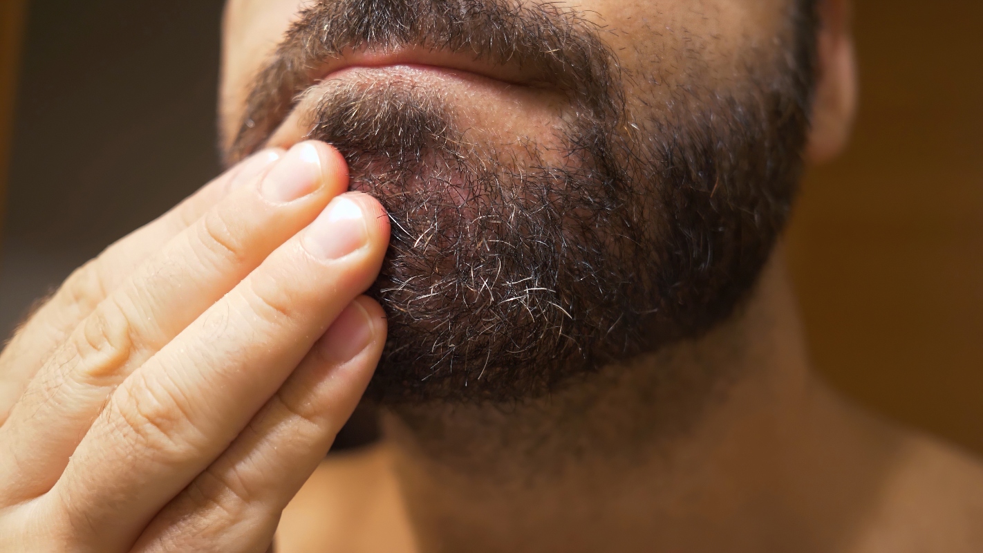 Dermatite seborroica: cos’è, cause, sintomi, quanto dura, trattamenti e rimedi naturali 2 dermatite seborroica: cause