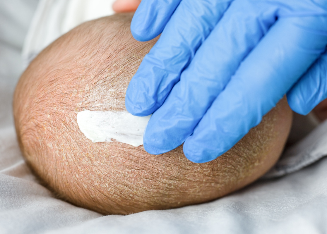 Dermatite seborroica: cos’è, cause, sintomi, quanto dura, trattamenti e rimedi naturali 4 dermatite seborroica: cure