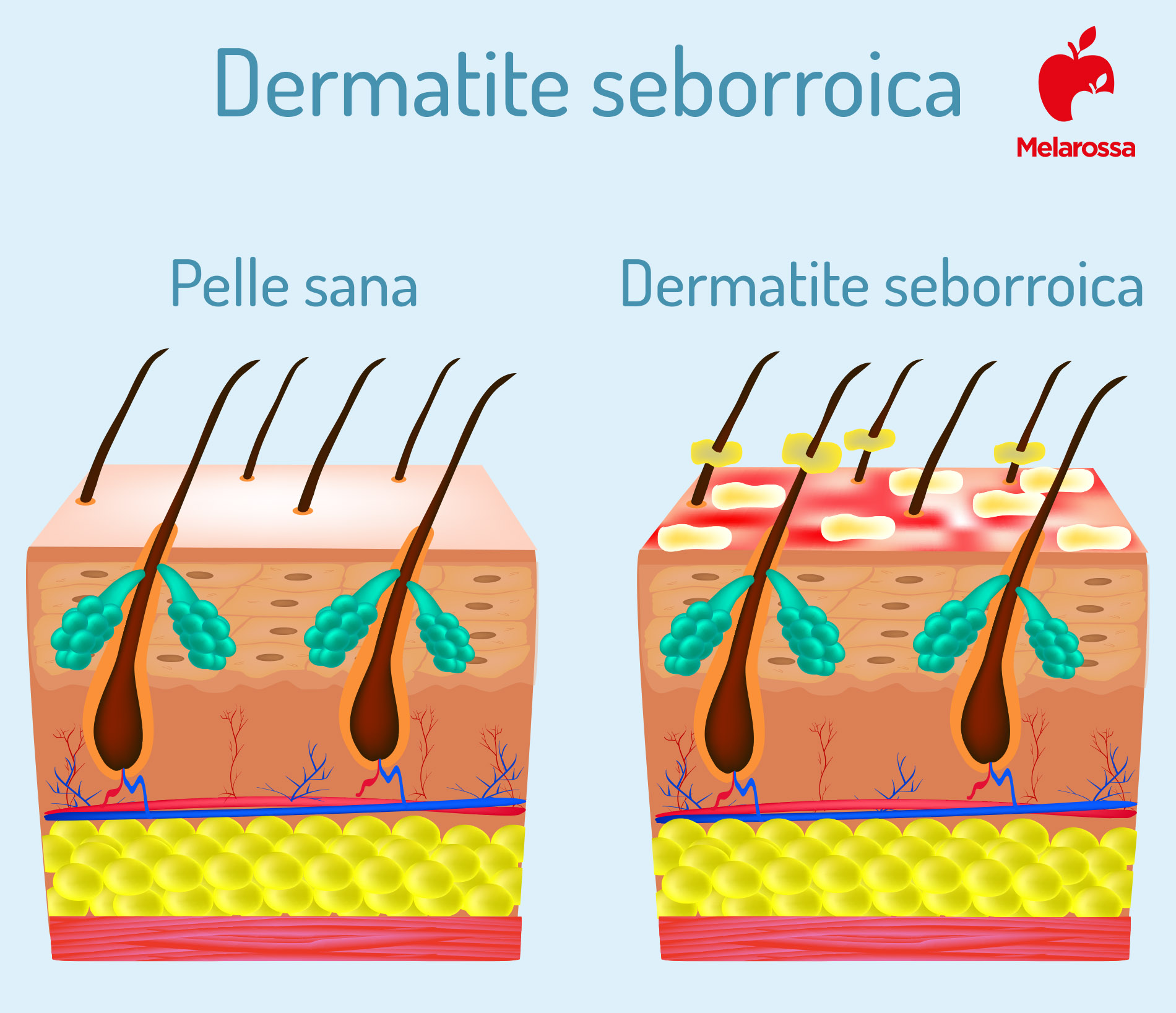 Dermatite seborroica: cos’è, cause, sintomi, quanto dura, trattamenti e rimedi naturali 1 dermatite seborroica: cos'è