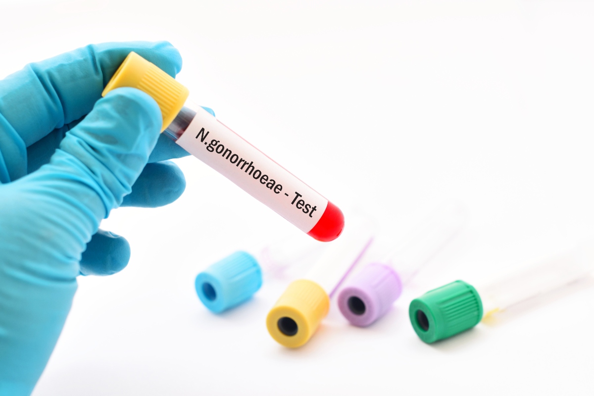 Gonorrea: cos’è, cause, come si trasmette, sintomi, cure e come prevenire l’infezione 4 gonorrea: quando fare il test