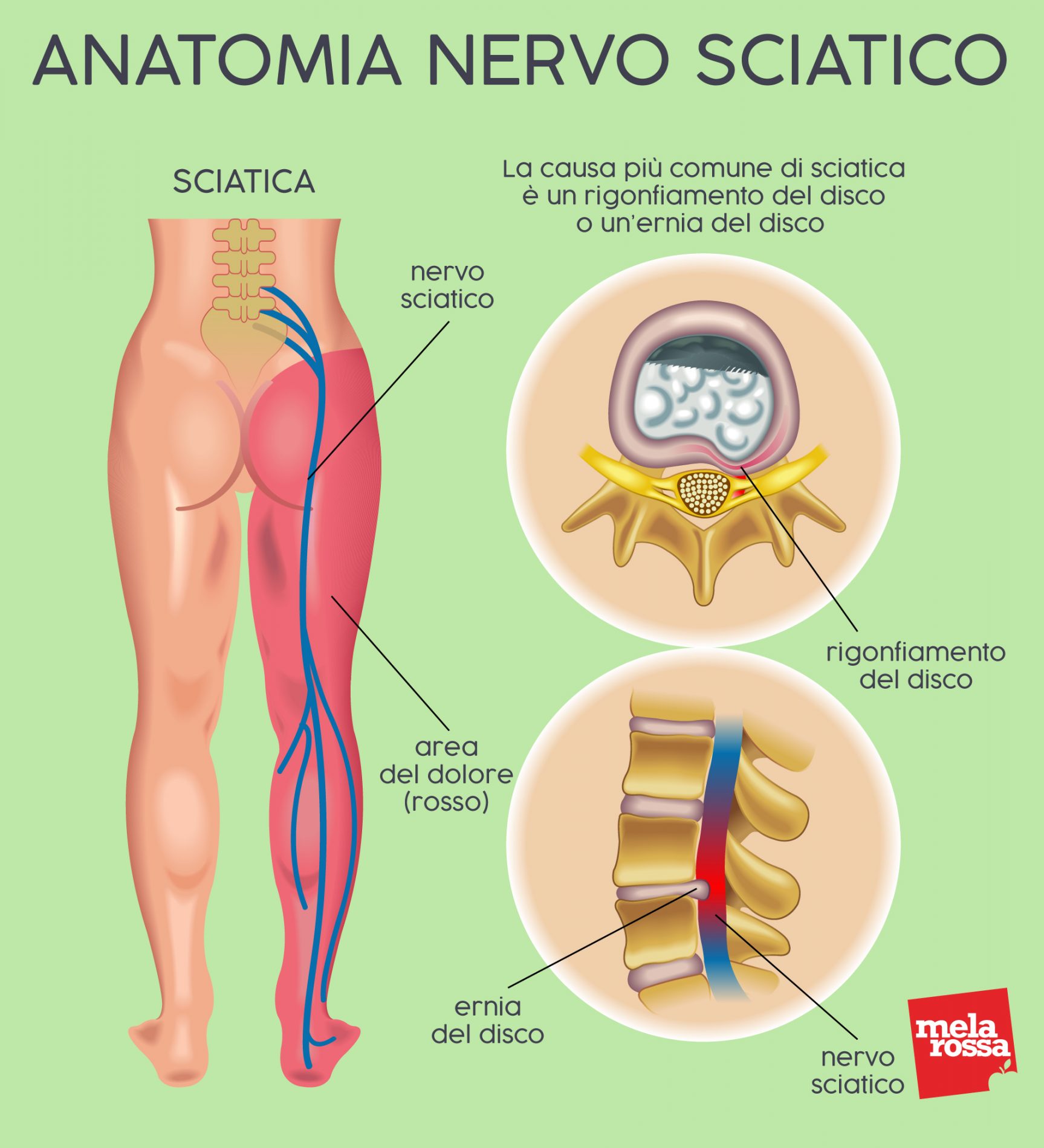 Lombosciatalgia: cos’è, dolori acuti e cronici, cause, cure e prevenzione 1 lombosciatalgia: anatomia del nervo sciatico