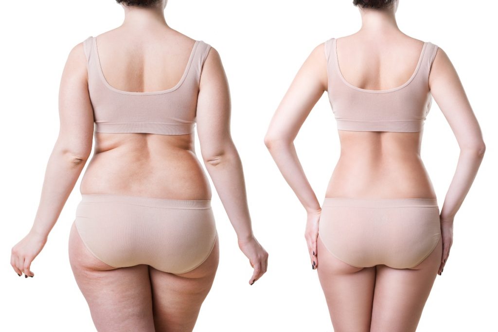 Lombosciatalgia: cos’è, dolori acuti e cronici, cause, cure e prevenzione 6 lombosciatalgia fattori di.rischio sovrappeso