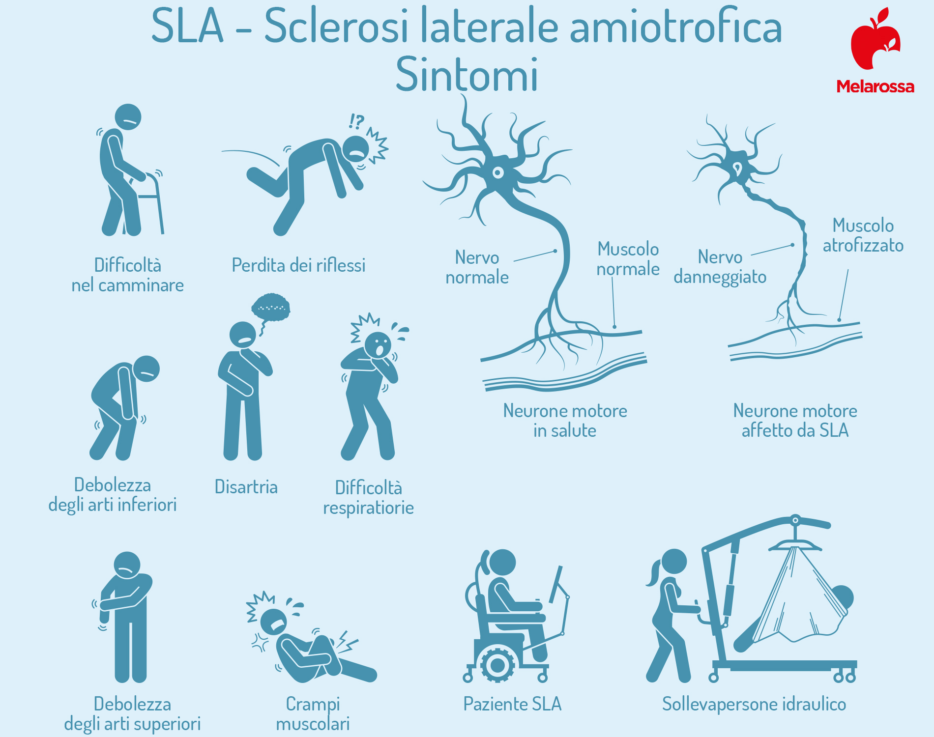 SLA o Sclerosi Laterale Amiotrofica : cos’è, chi colpisce, sintomi, cause, diagnosi, terapie disponibili e assistenza malati 4 SLA: sintomi