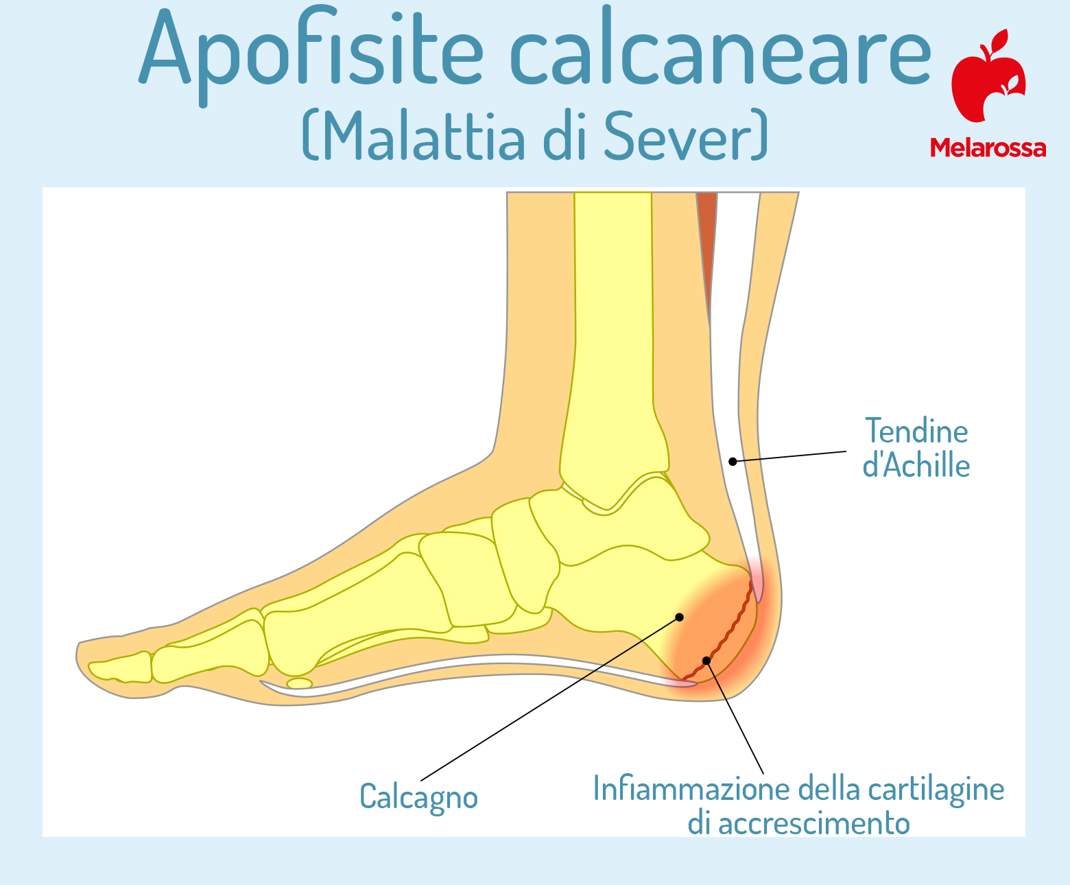 Tallonite: che cos'è, sintomi, quanto dura, cause, trattamenti e rimedi naturali per alleviare il dolore 3 tallonite nei bambini: la malattia di Sever