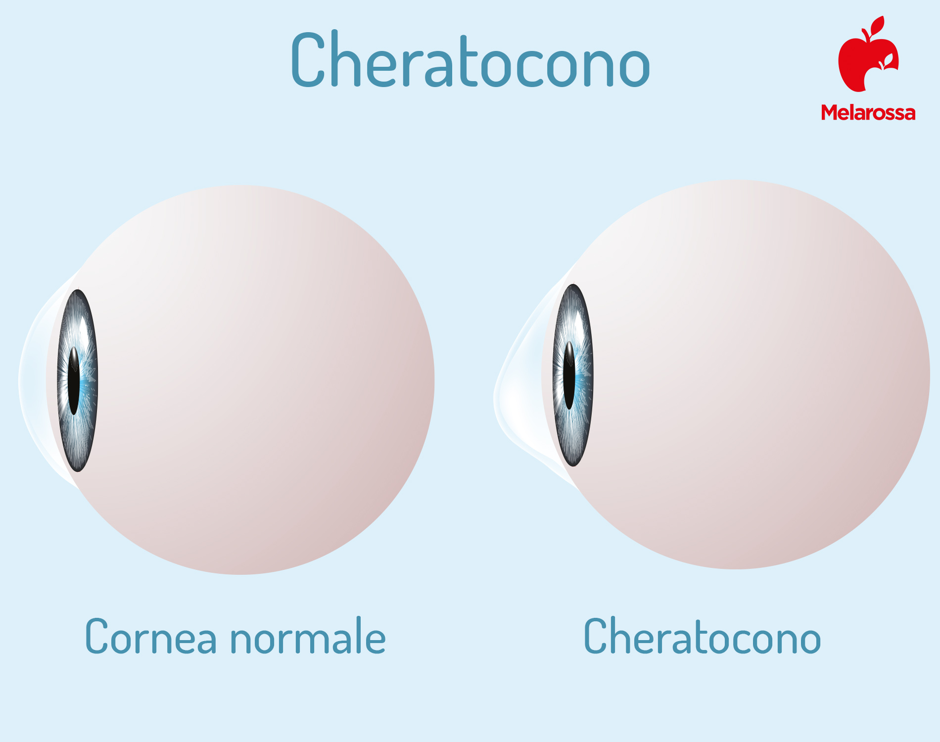 Cheratocono, malattia degenerativa della cornea: cos’è, cause, sintomi e cure 1 cheratocono: foto
