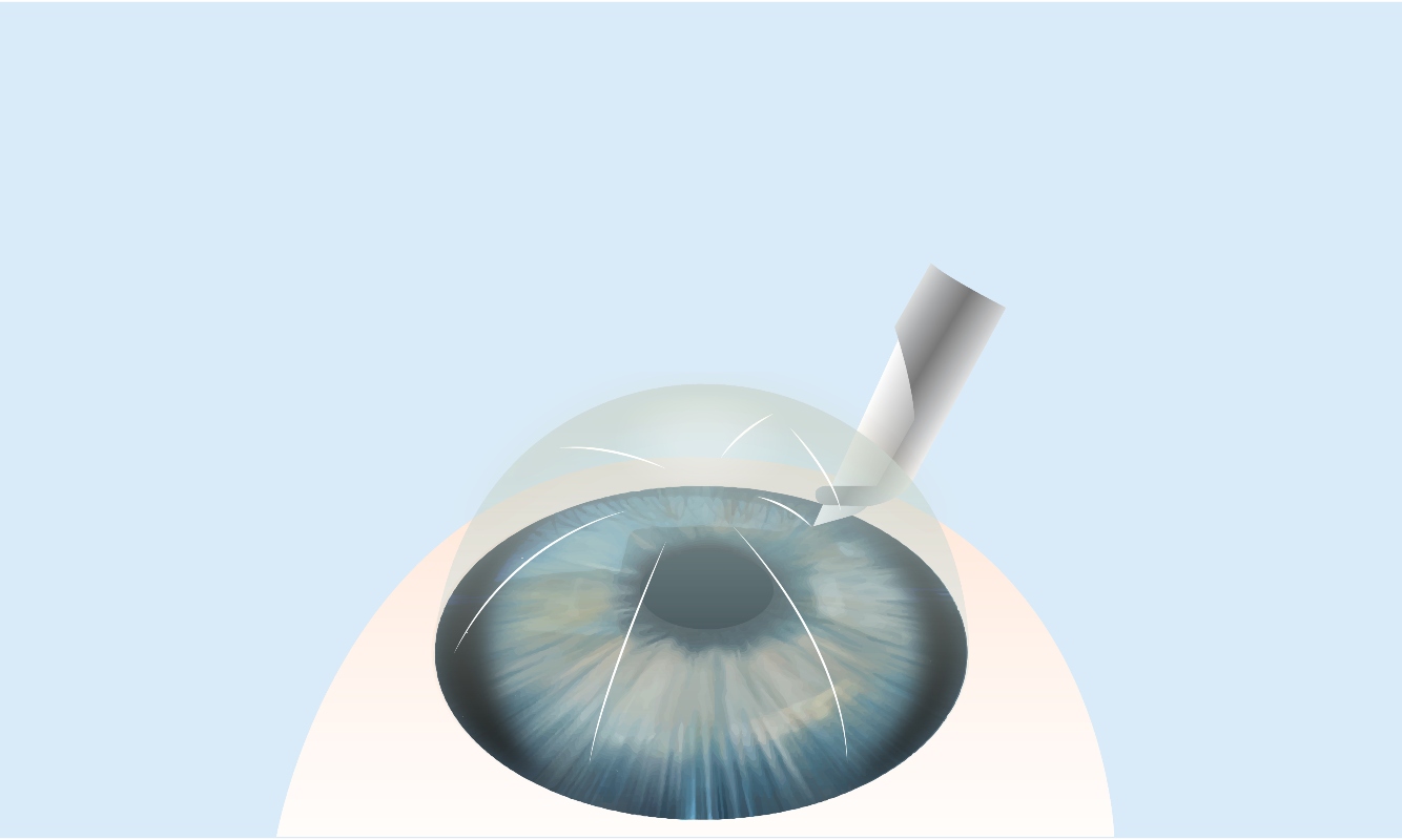 Cheratocono, malattia degenerativa della cornea: cos’è, cause, sintomi e cure 8 cheratocono: cure, quando fare intervento chirurgico