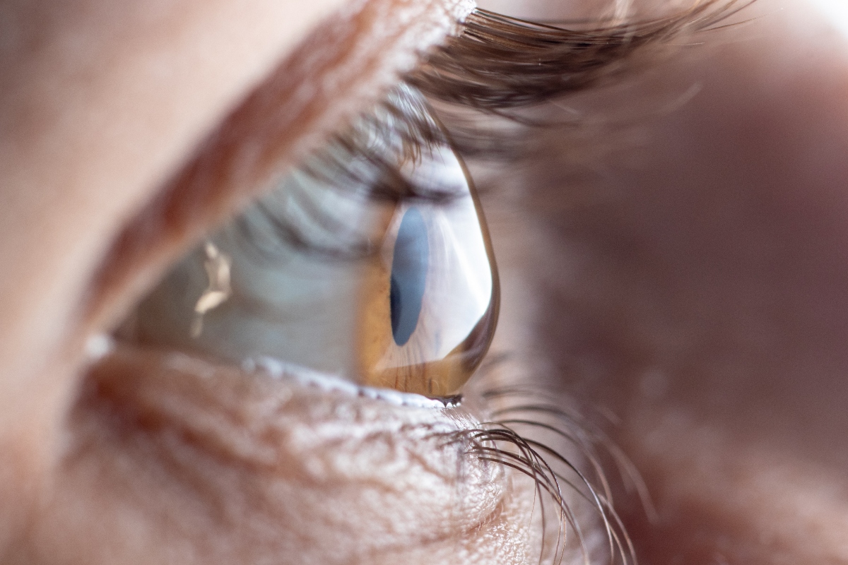 Cheratocono, malattia degenerativa della cornea: cos’è, cause, sintomi e cure 6 cheratocono: sintomi