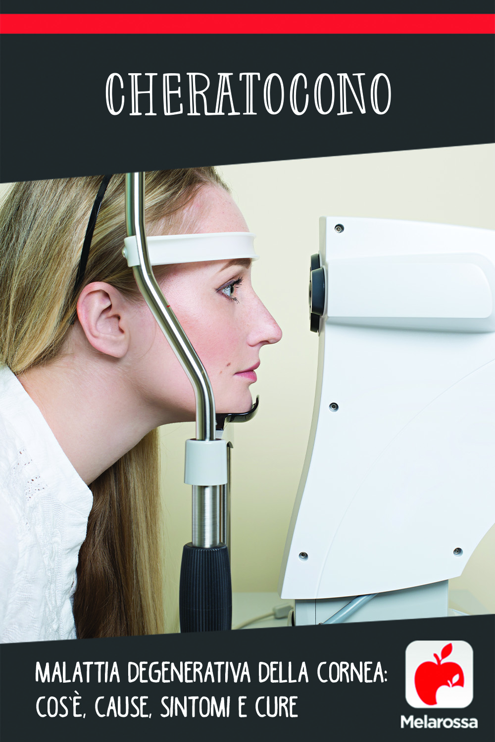 Cheratocono, malattia degenerativa della cornea: cos’è, cause, sintomi e cure 10 cheratocono: cos'è, cause, sintomi e cure