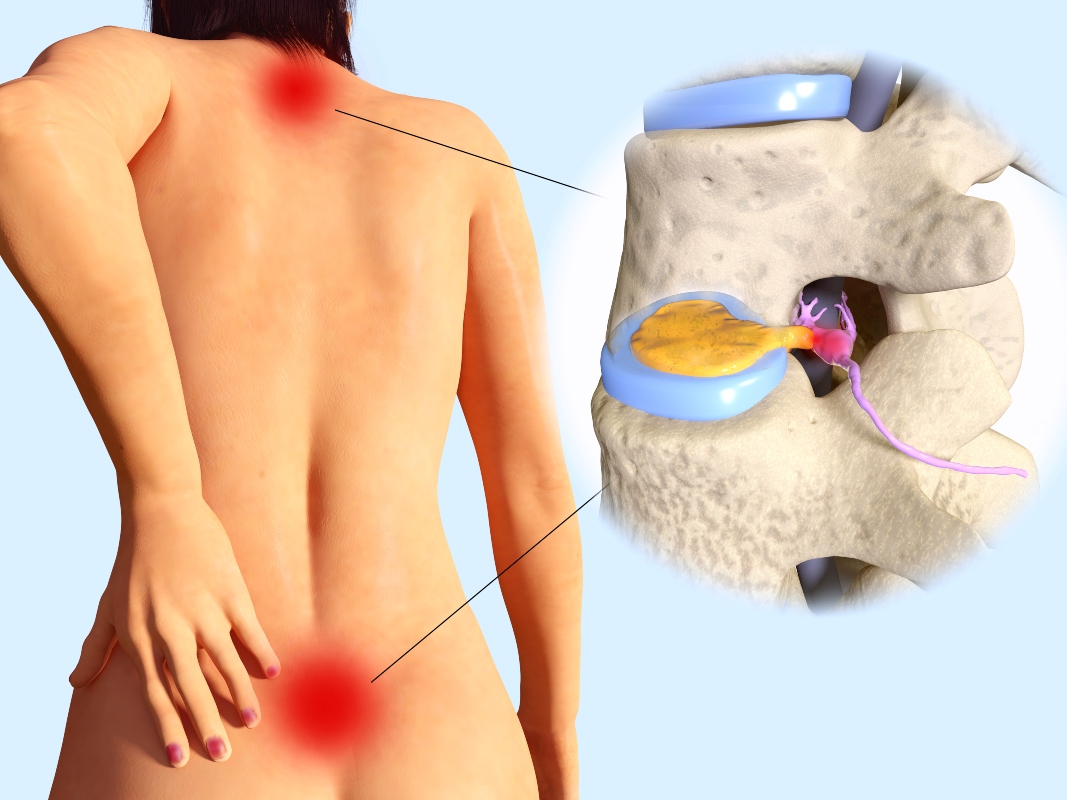 Mal di schiena: cos'è, tipi, sintomi, cause, quando preoccuparsi, trattamenti e prevenzione 4 mal di schiena: discopatia lombare e cervicale- Foto