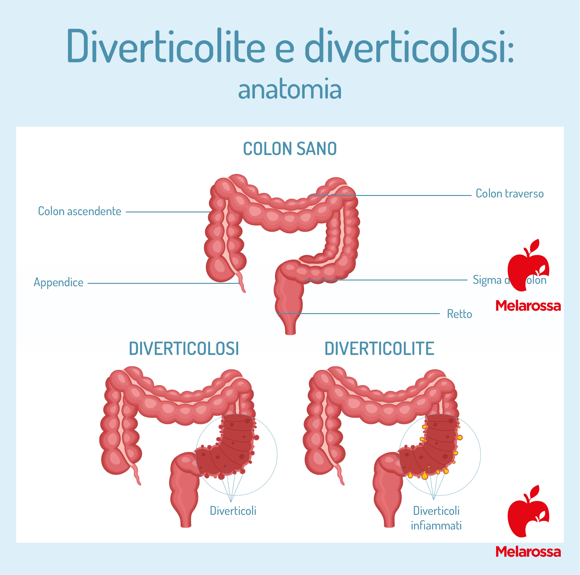 Diverticolite e diverticolosi: cause, sintomi, cure e dieta da seguire per stare meglio 4 Diverticolite e diverticolosi: anatomia