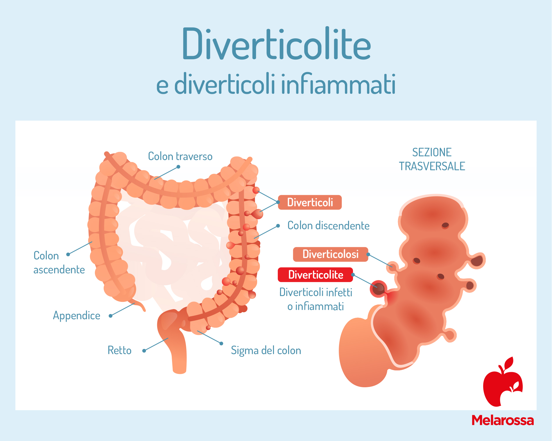 Diverticolite e diverticolosi: cause, sintomi, cure e dieta da seguire per stare meglio 2 Diverticoli infiammati