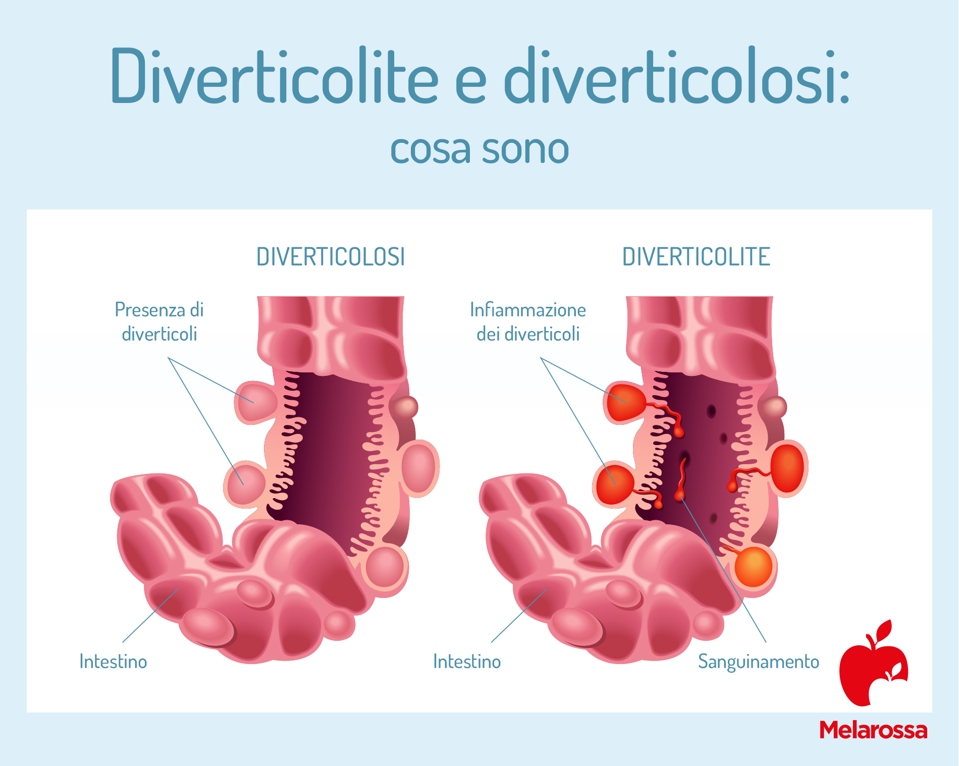Diverticolite e diverticolosi: cause, sintomi, cure e dieta da seguire per stare meglio 1 Diverticolite e diverticolosi: differenze