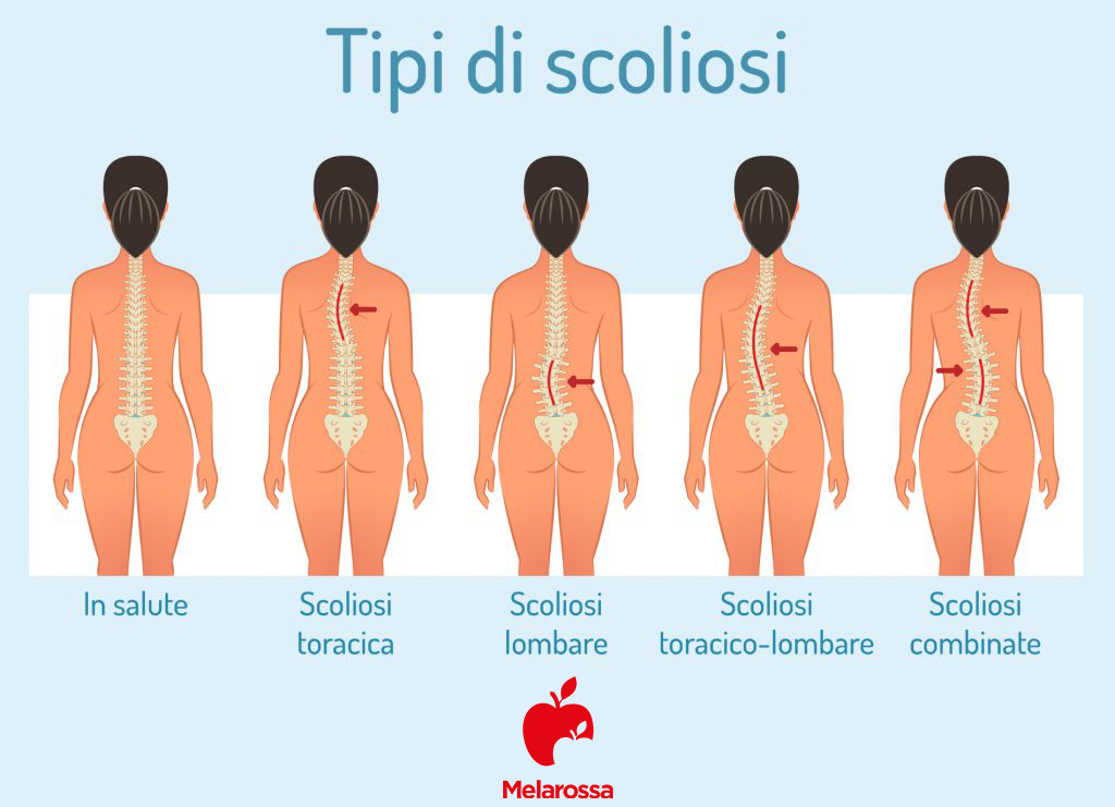 Mal di schiena: cos'è, tipi, sintomi, cause, quando preoccuparsi, trattamenti e prevenzione 5 mal di schiena: tipi di scoliosi- INFOGRAFICA