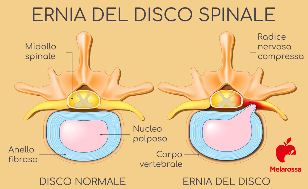Mal di schiena: cos'è, tipi, sintomi, cause, quando preoccuparsi, trattamenti e prevenzione 11 mal di schiena e ernia del disco