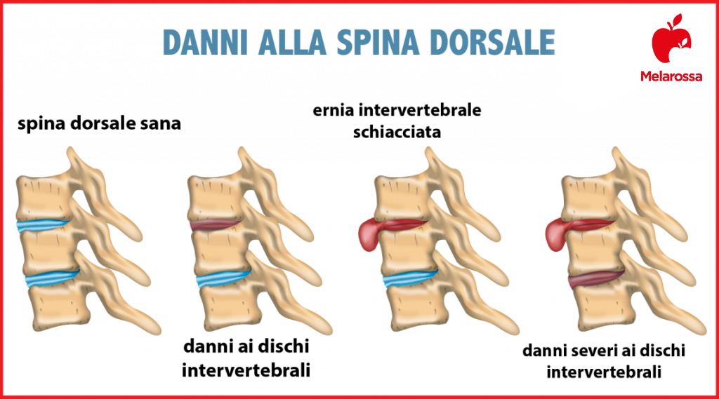 Mal di schiena: cos'è, tipi, sintomi, cause, quando preoccuparsi, trattamenti e prevenzione 7 lombalgia: mal di schiena