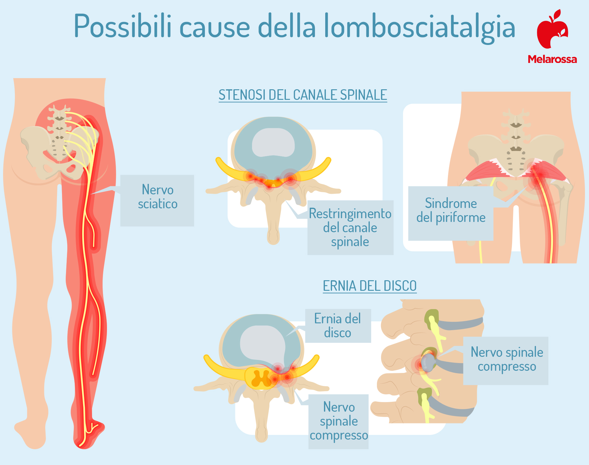 Mal di schiena: cos'è, tipi, sintomi, cause, quando preoccuparsi, trattamenti e prevenzione 9 mal di schiena e lombosciatalgia