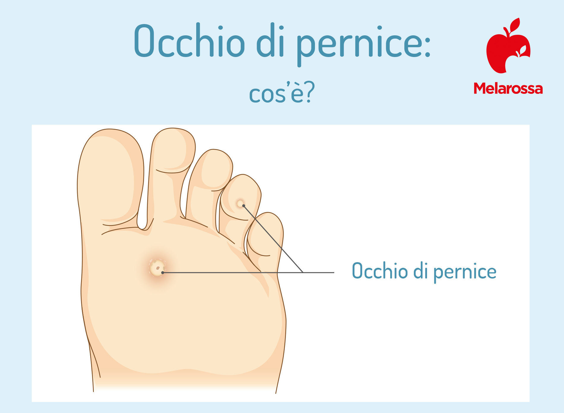 Occhio di pernice: che cos’è, trattamenti e rimedi naturali 1 occhio di pernice: cos'è
