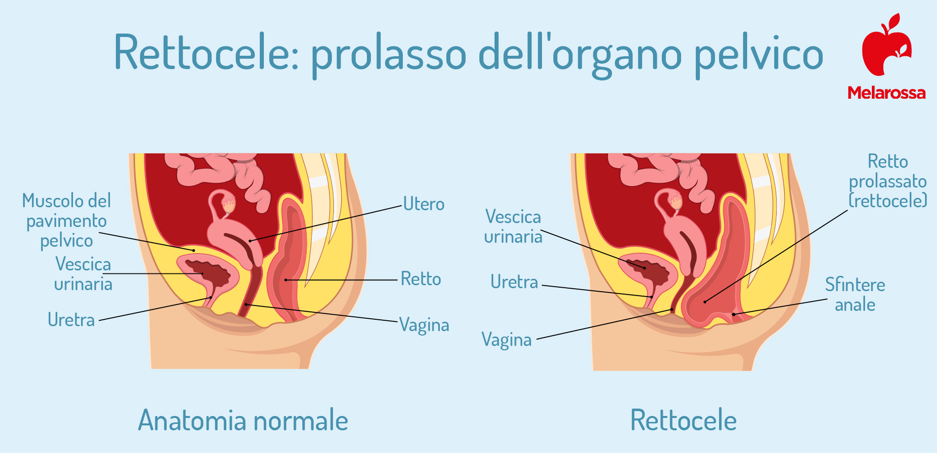 Perineo: cos’è, anatomia, funzioni, patologie, cure e prevenzione 4 perineo: prolasso vaginale