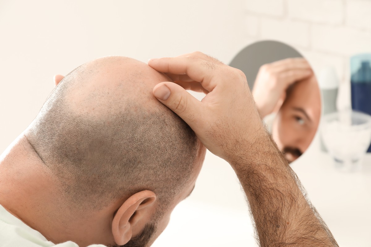 Trapianto capelli: cos'è, costo e come funziona 1 autotrapianto di capelli