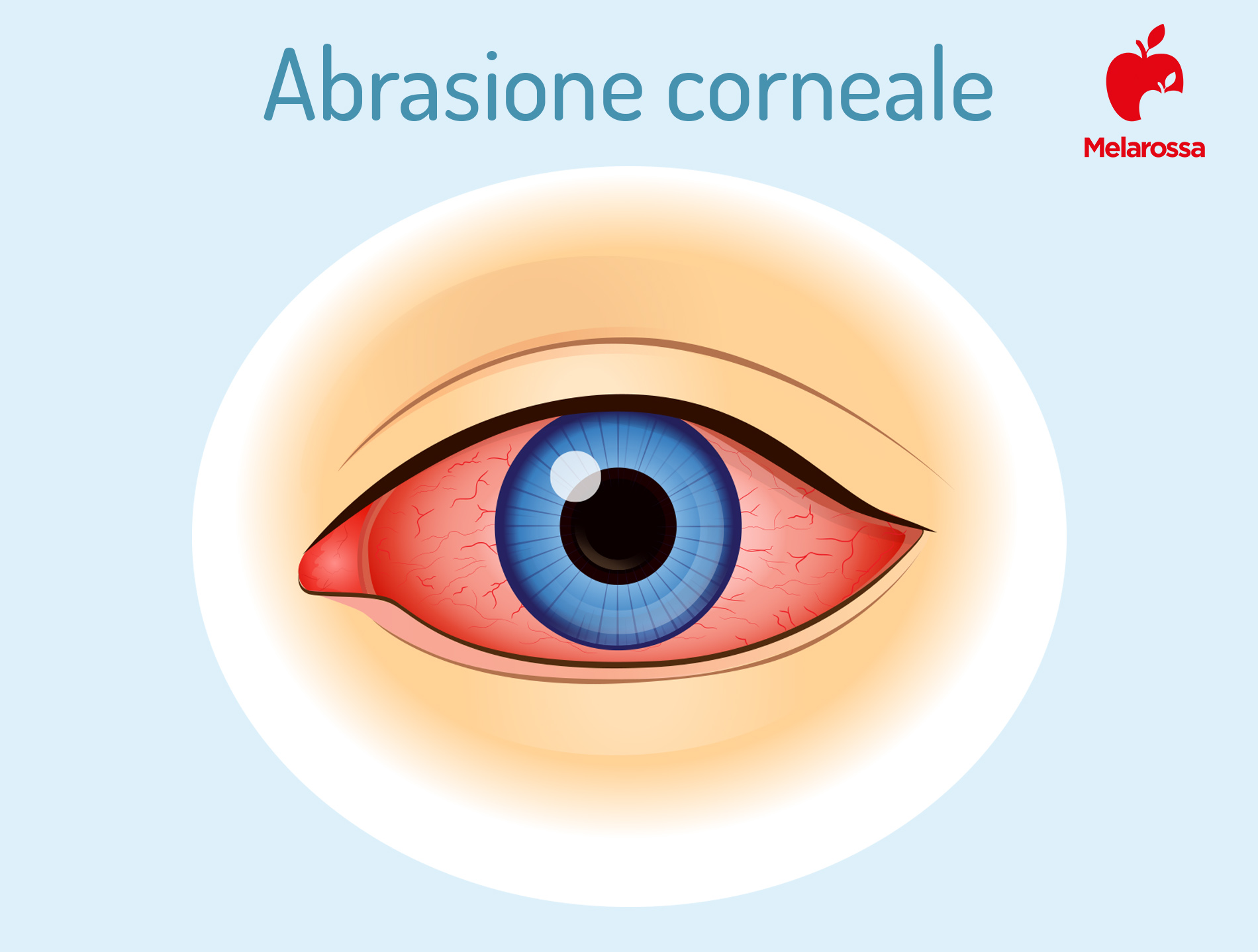 Cornea: cos’è, anatomia, funzioni, principali patologie, trattamenti e cure 7 abrasione corneale: sintomi