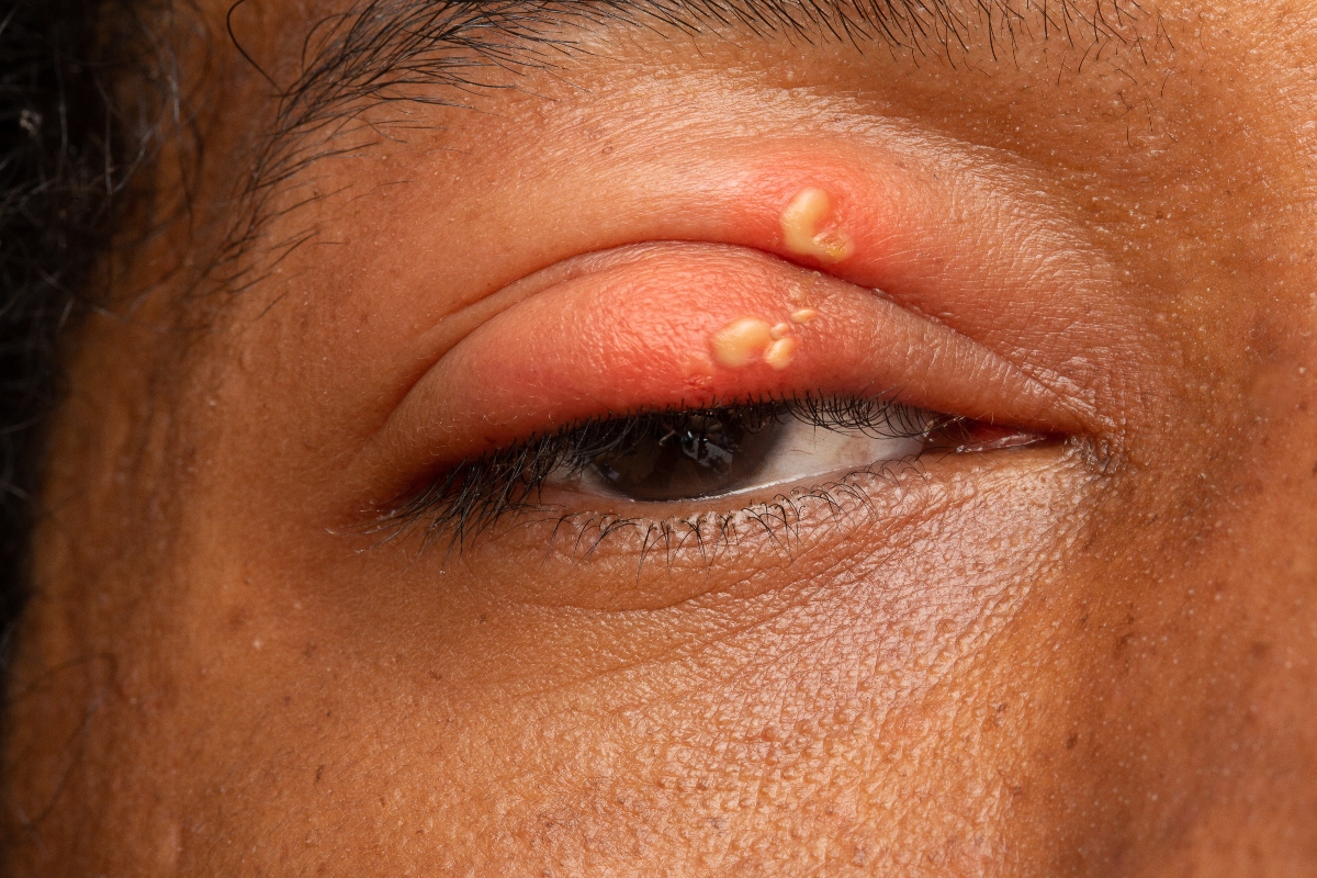 Cornea: cos’è, anatomia, funzioni, principali patologie, trattamenti e cure 8 cornea: malattie infettive