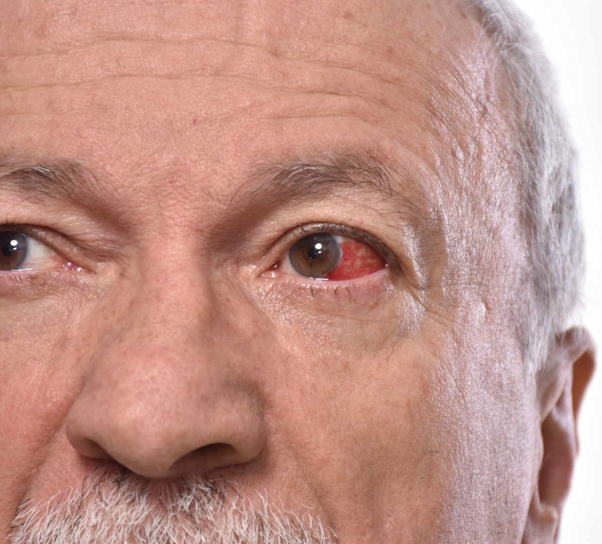 Cornea: cos’è, anatomia, funzioni, principali patologie, trattamenti e cure 11 le patologie della cornea