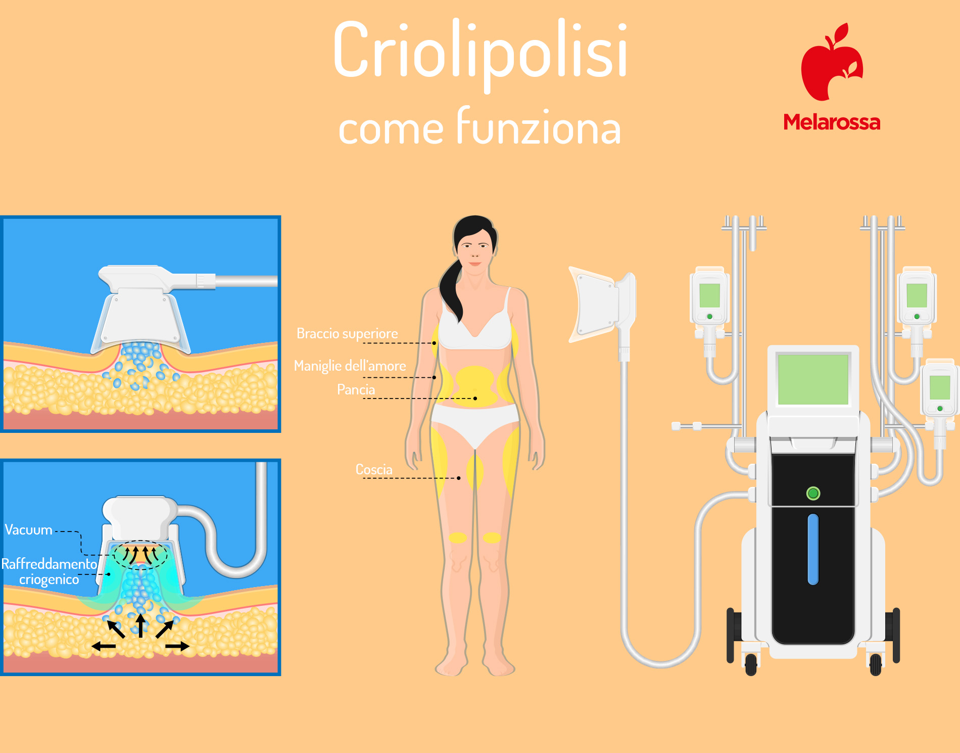 Criolipolisi: cos'è, come funziona, costi, prima e dopo 1 grafica che illustra come funziona una seduta di criolipolisi con una donna in centro e il macchinario a destra. A sinistra come funziona la seduta