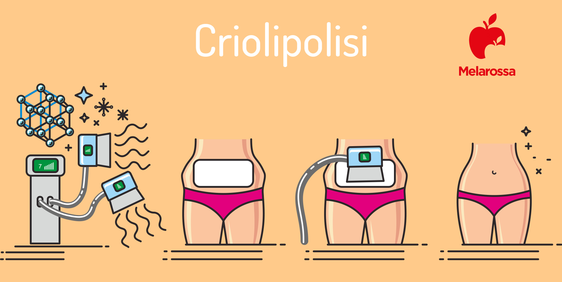 Criolipolisi: cos'è, come funziona, costi, prima e dopo 2 Grafica con apparecchio di criolipolisi e come viene fatto il trattamento con la terza pancia dimagrita