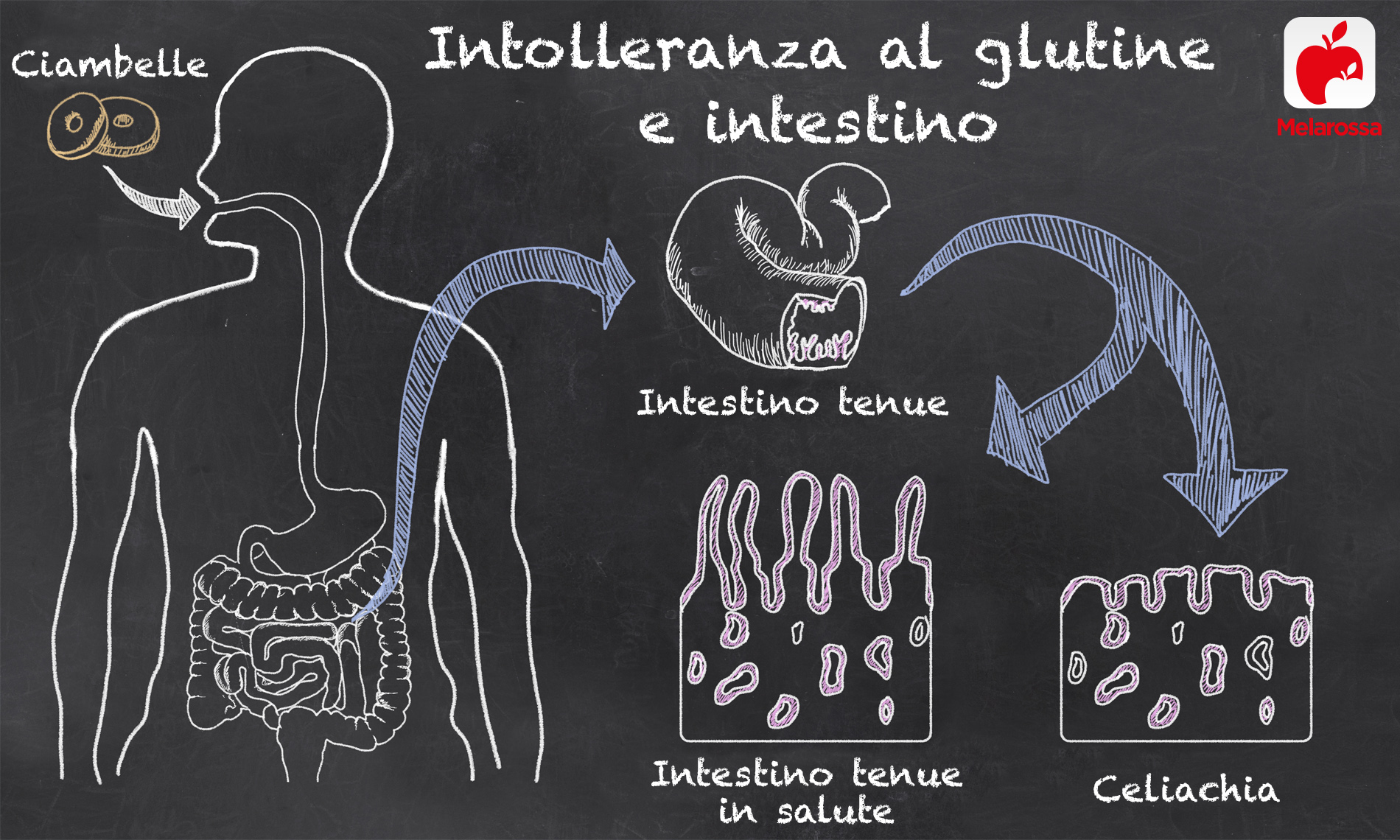 Glutine: cos’è, a cosa serve, alimenti gluten free e intolleranze 7 una grafica sull'intolleranza al glutine e intestino