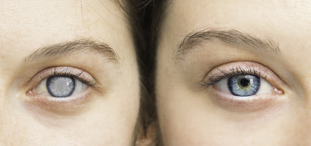 Cornea: cos’è, anatomia, funzioni, principali patologie, trattamenti e cure 6 patologia della cornea: leucocoria