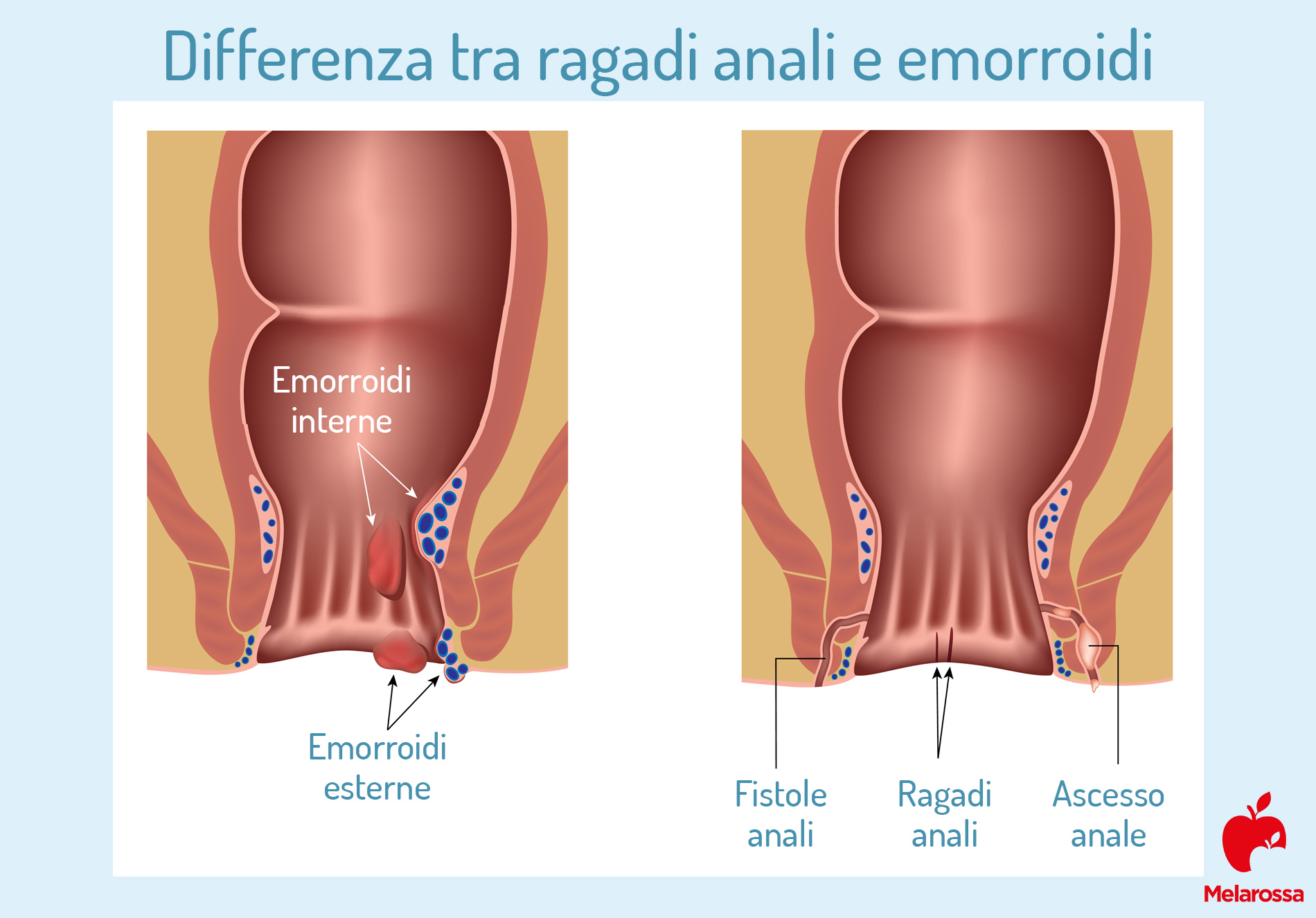 Ragadi anali: cosa sono, cause, sintomi, diagnosi, cure e prevenzione 3 ragadi anali cosa sono
