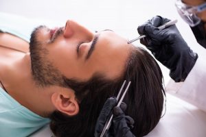 Trapianto capelli: cos&rsquo;&egrave;, costo e come funziona