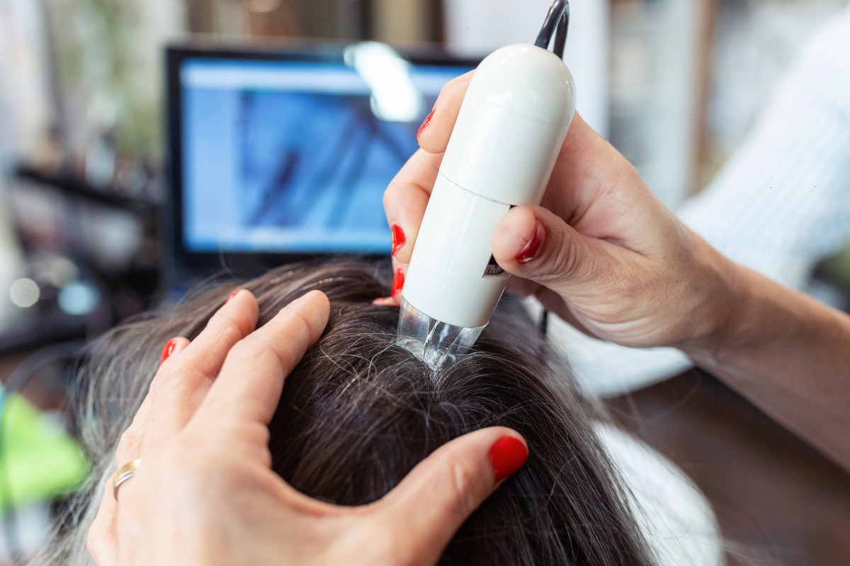 Trapianto capelli: cos'è, costo e come funziona 4 trapianto capelli funziona